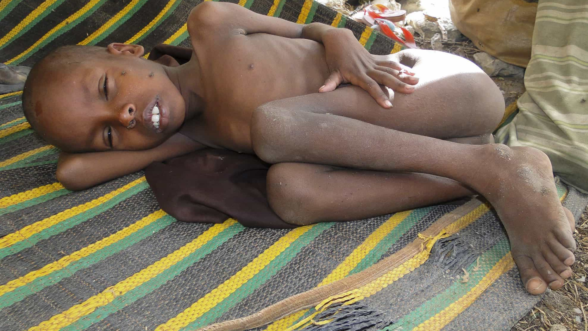 Um milhão de crianças tem desnutrição grave na África, diz UNICEF