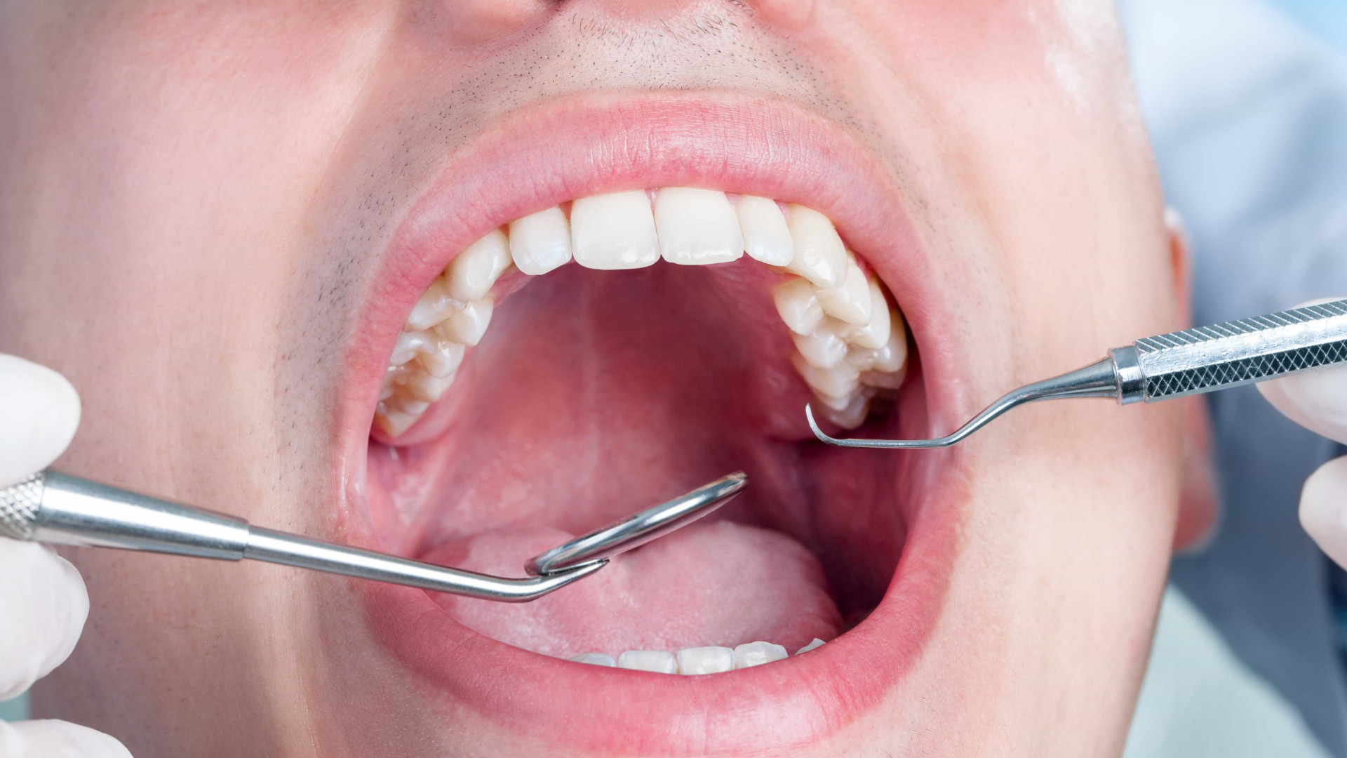 O dente do siso deve sempre ser retirado? Especialista explica