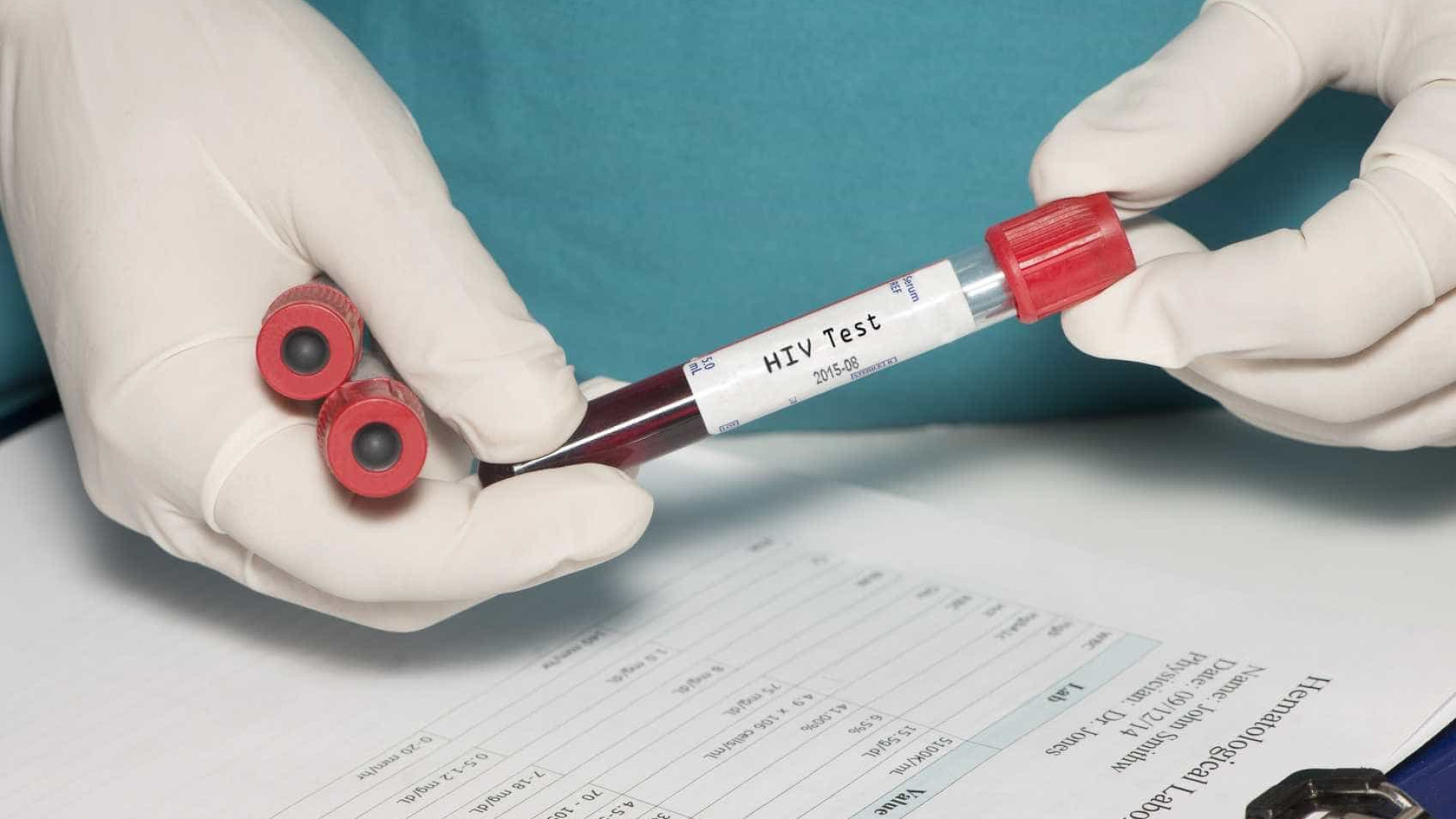 Cientistas detectam 2º caso de remissão total do HIV