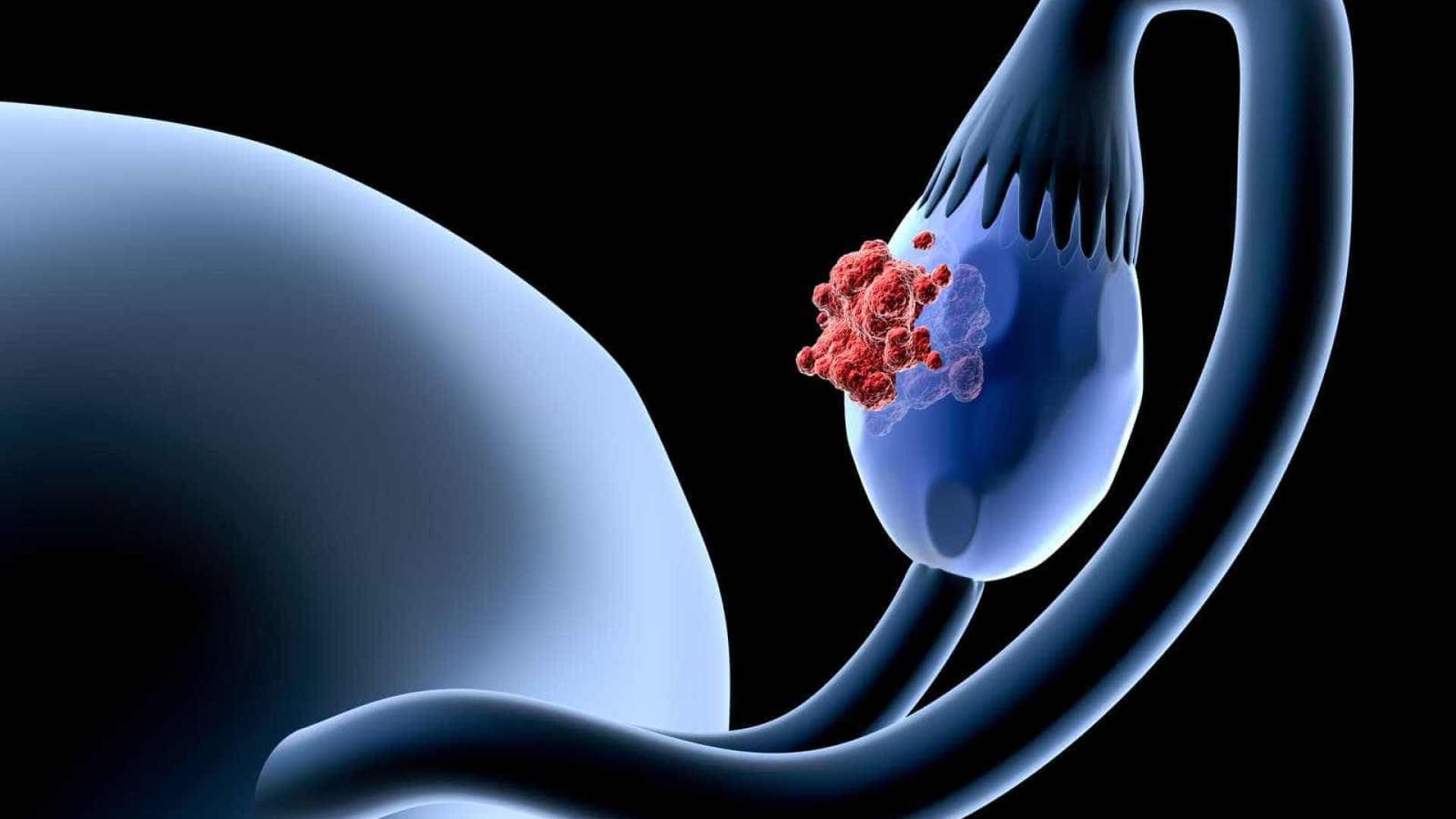 You should not ignore the early and painful signs of ovarian cancer