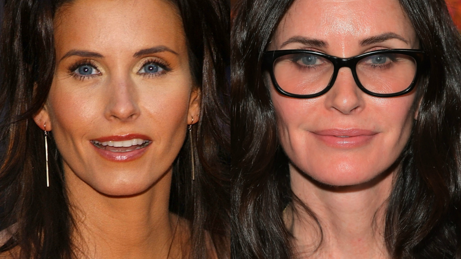 Antes e depois: a transformação das famosas que usaram botox