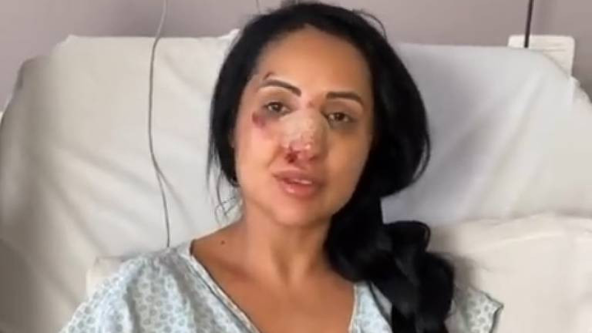 Irmã de Deolane Bezerra briga em bar de São Paulo e tem nariz quebrado