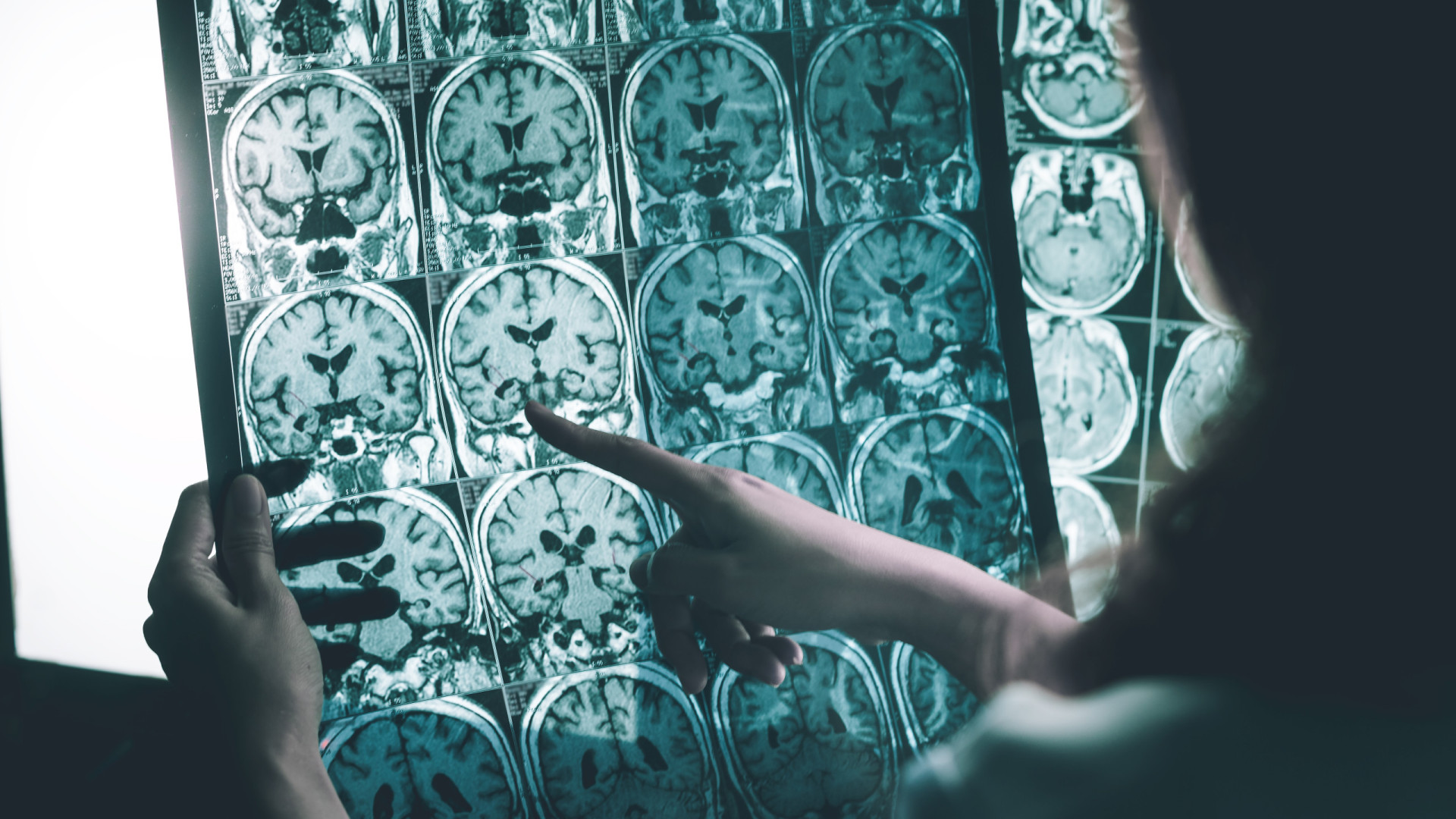 Há um novo teste capaz de identificar Alzheimer antes da perda de memória