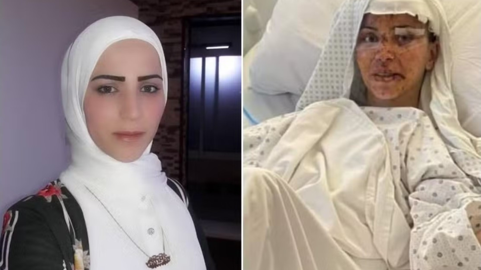 Brasileira ferida em bombardeio no Líbano recebe alta de hospital