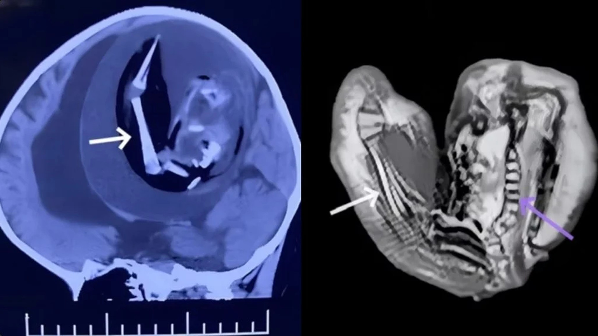 Bebê chinesa nasce com irmão gêmeo "parasita" no crânio