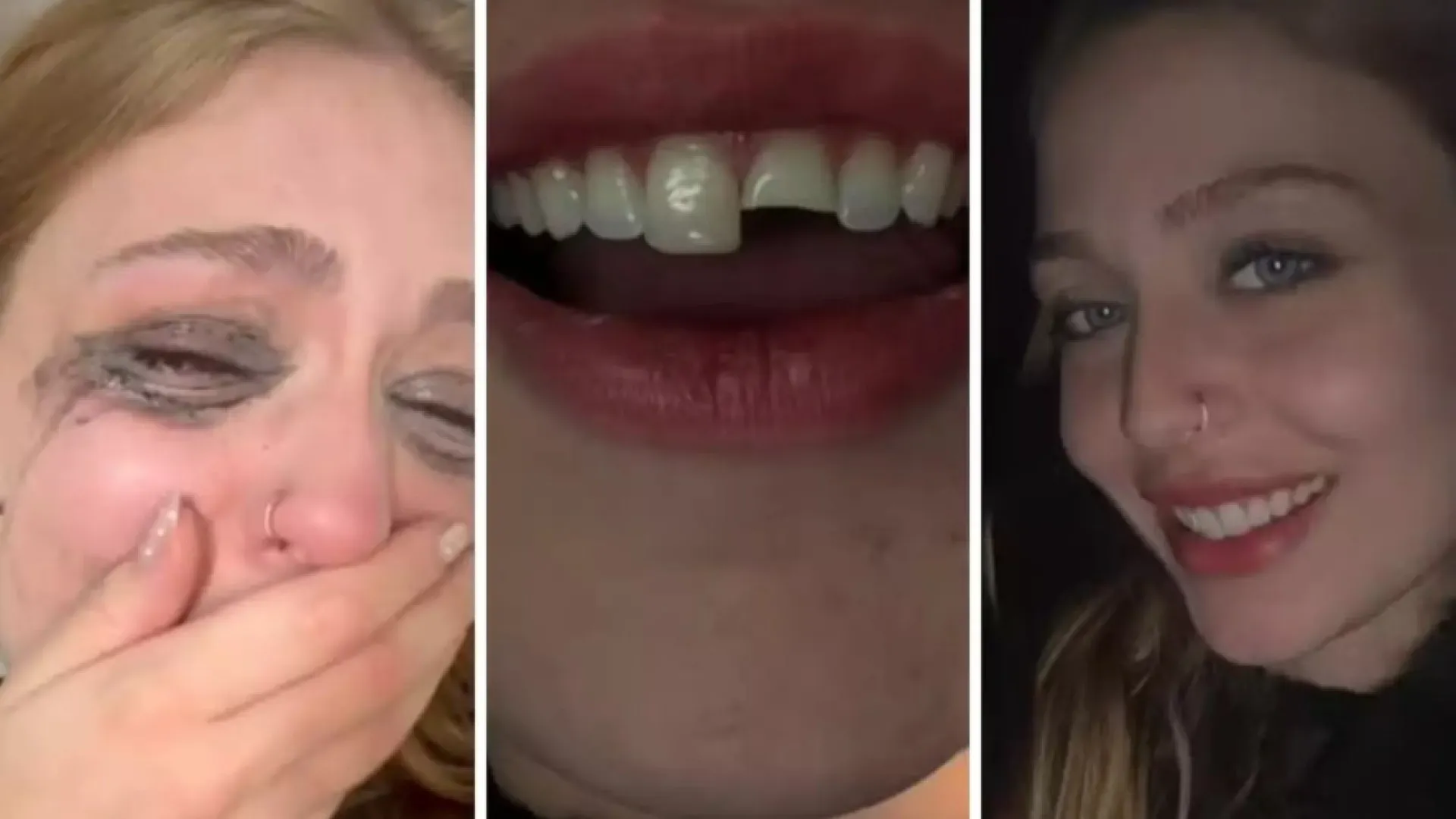 Young man breaks teeth at a club in PR, cheats at dawn and returns to the party