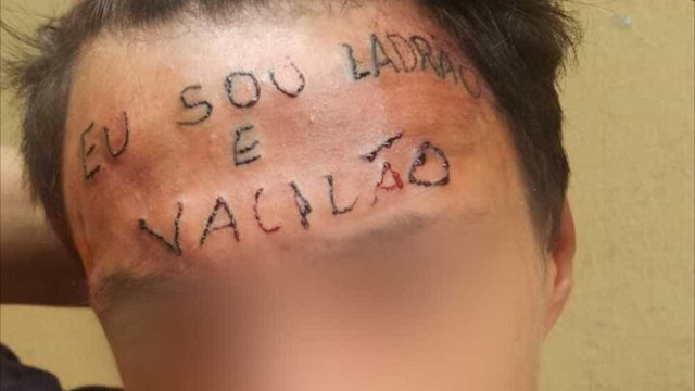 Adolescente tatuado na testa passa pela 1ª sessão para remover frase