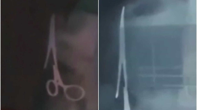 Homem é operado para retirar tesoura esquecida em cirurgia há 18 anos