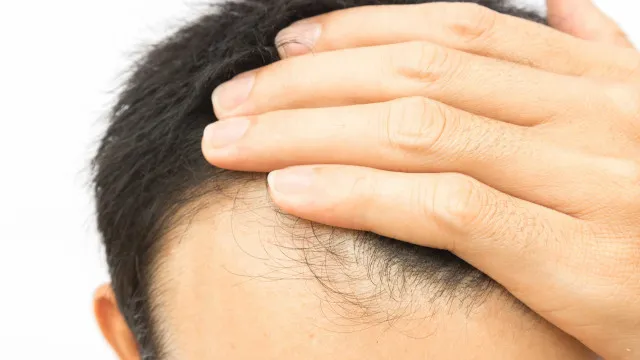 
                    Cabelo transplantado pode cair? Veja alguns detalhes sobre o procedimento
                