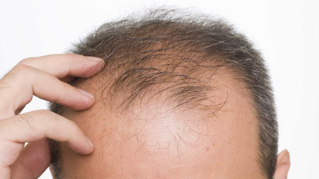 Um a cada quatro pacientes apresentam queda de cabelo após Covid-19