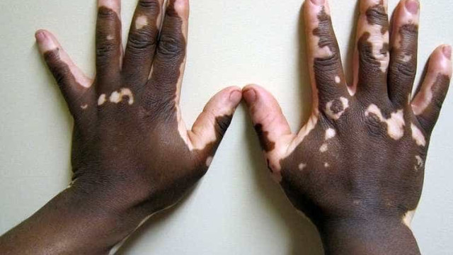 Homem com vitiligo na Bahia tenta provar que é pardo para se manter em curso de medicina