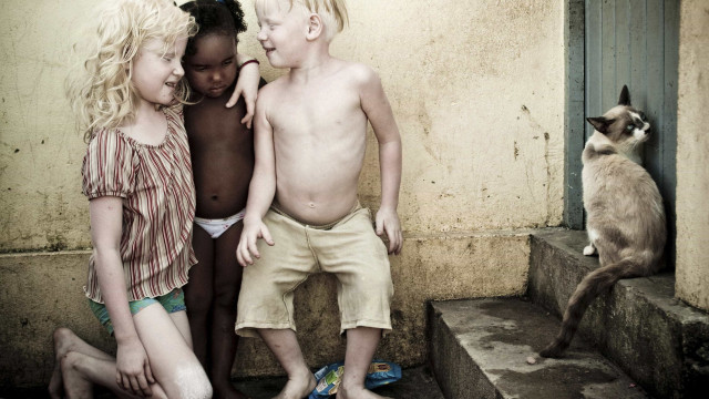 Em 10 anos, 85 pessoas morreram por problemas associados ao albinismo