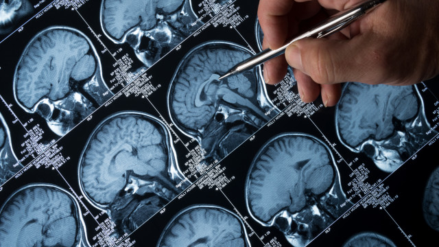 Alzheimer: EUA aprovam novo remédio que pode desacelerar a doença