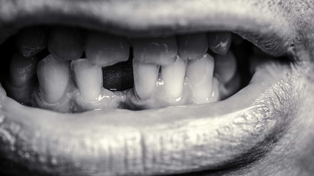 Queda repentina de dentes pode ser mais um sintoma da Covid-19