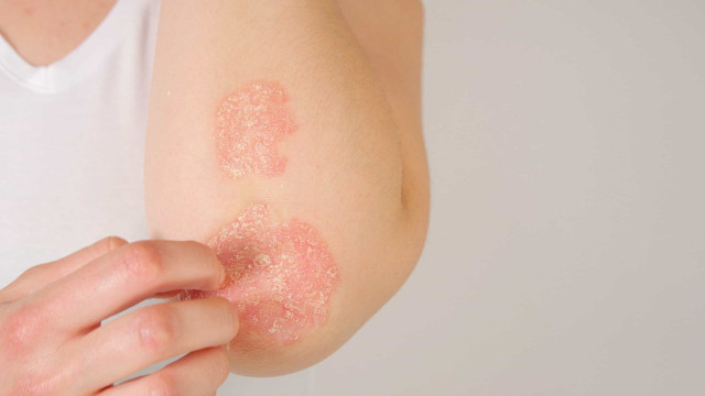 Pesquisadores desenvolvem tratamento natural contra a psoríase