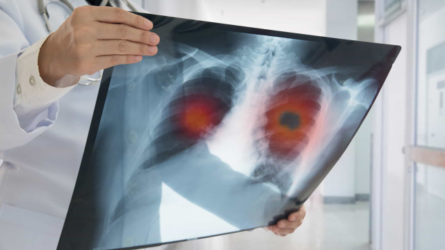 Câncer de pulmão: medicamento reduz em 51% risco de morte em pacientes
