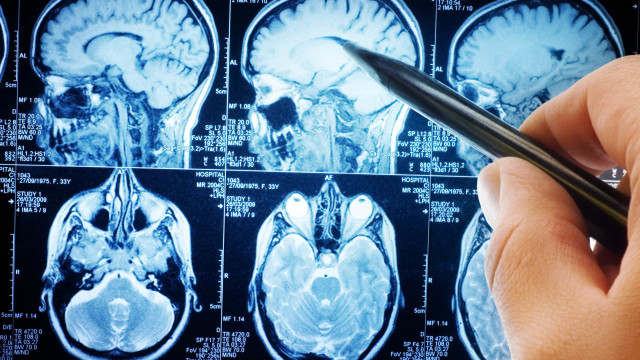 Duas mulheres com paralisia voltam a falar após implantes no cérebro