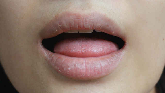 Conheça os sintomas e saiba como se prevenir contra o câncer de boca