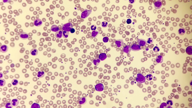 Sintomas de leucemia mieloide crônica que todos precisam conhecer