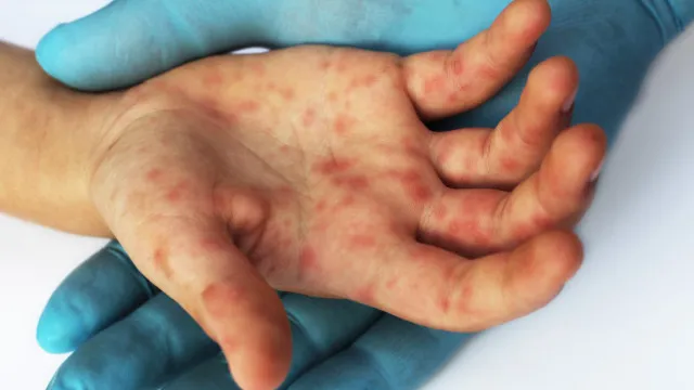 
                    Ministério da Saúde confirma caso de sarampo no Rio de Janeiro
                