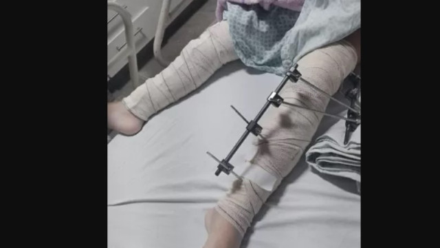 Menina de 6 anos tem pinos colocados em perna errada