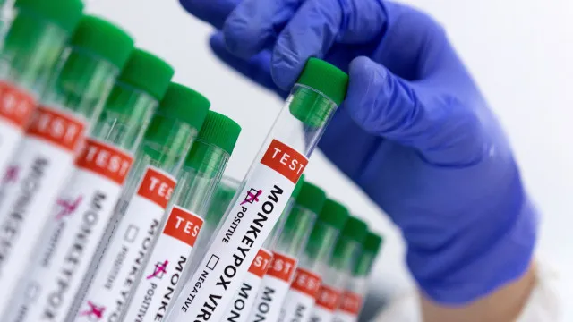 
                    Mpox aumenta no Brasil e reacende alerta para monitoramento e vigilância
                