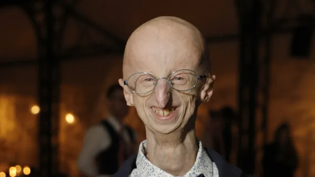 Morre Sammy Basso, o jovem mais velho com doença rara genética 