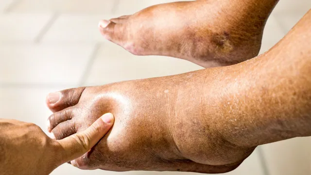 
                    Corpo inchado? Pode ser mais sério do que parece!
                