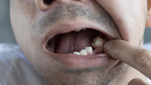 
                    Coisas que fazem seu dente cair
                