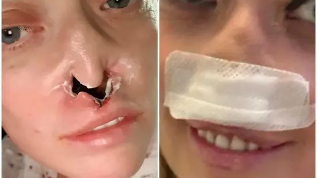 
                    Mulher faz implante dentário e fica com ‘buraco’ no rosto: “Dói muito