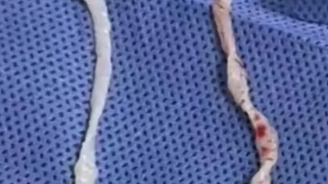 
                    Mulher cozinhava rãs e acabou com dois parasitas de 10 cm no corpo
                