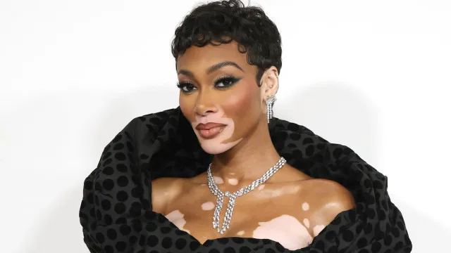 
                    Famosos que sofrem de vitiligo: 