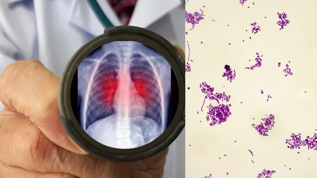 
                    Peste pneumônica: o que é, os riscos e como se transmite esta infecção
                