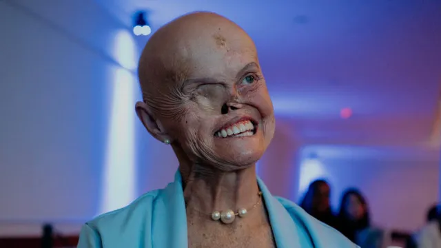 
                    Brasileira sobreviveu a 73 cânceres de pele; agora aguarda por cirurgia
                