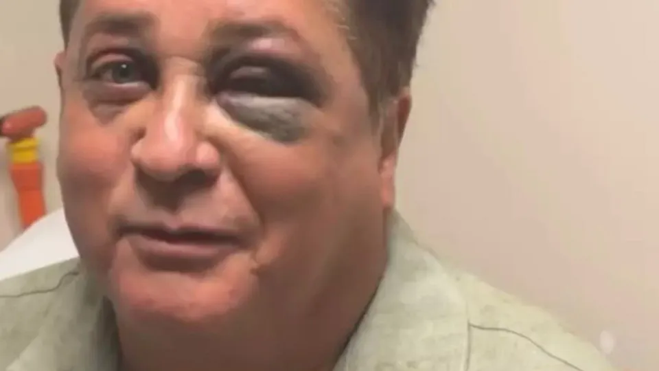 Leonardo revela fratura no rosto após queda em pescaria